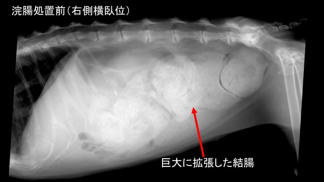 巨大結腸症